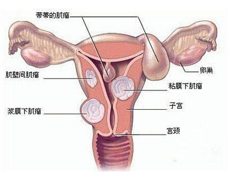 子宫肌瘤为什么会引起不孕呢